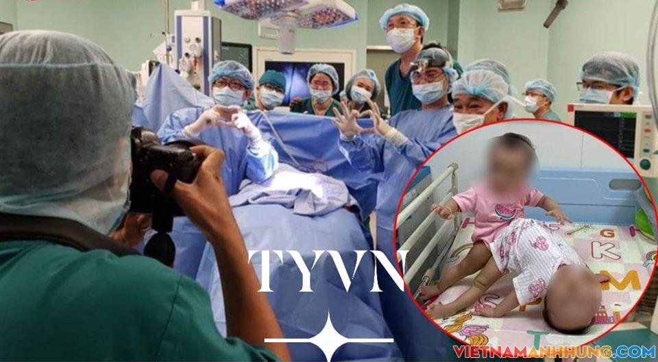 Nóng: Đã phẩu thuật tách cặp song sinh dính liền nhau thành công