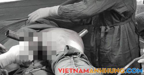 Cấp cứu thành công thanh niên bị ống sắt đâm xuyên vùng bẹn