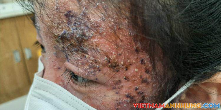 Bé gái 8 tuổi bị tổn thương nửa khuôn mặt do tự bôi thuốc trị nấm