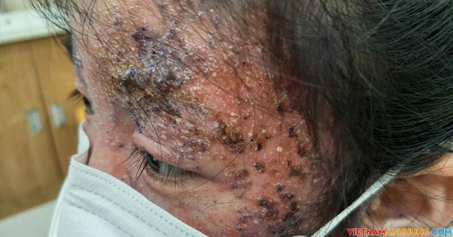 Bé gái 8 tuổi bị tổn thương nửa khuôn mặt do tự bôi thuốc trị nấm