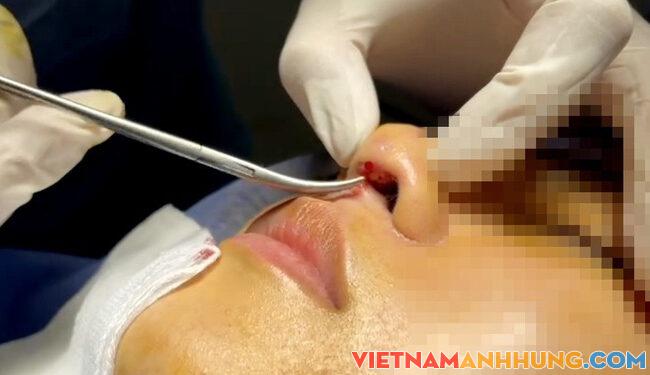 Mang đôi mắt “thảm họa”, phải nhập viện thẩm mỹ khẩn sau giãn cách