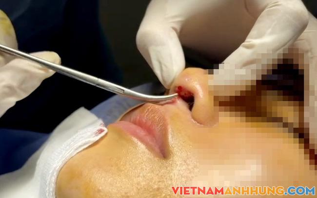 Mang đôi mắt “thảm họa”, phải nhập viện thẩm mỹ khẩn sau giãn cách
