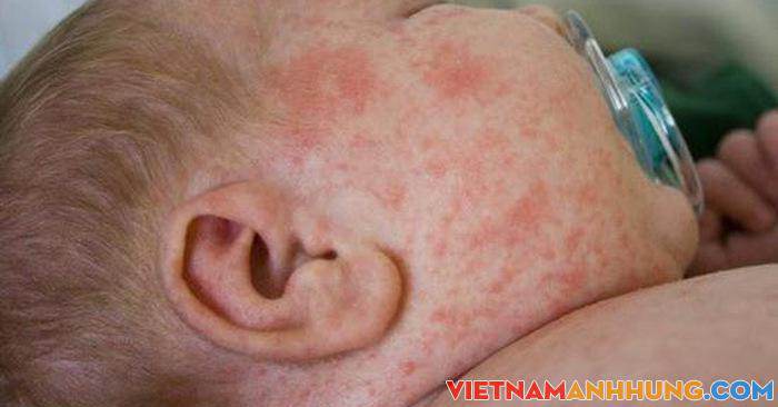 Bị sốt xuất huyết nhập viện muộn, bé gái viêm não, tổn thương cơ tim