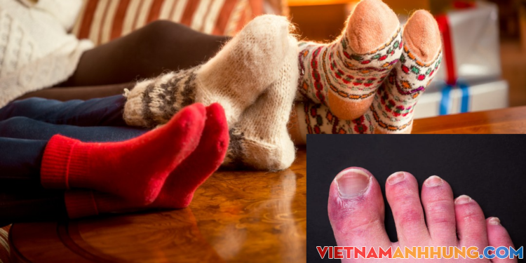Khổ vì ngón chân sưng và ngứa vào mùa đông, làm thế nào để ngón chân không sưng, ngứa?