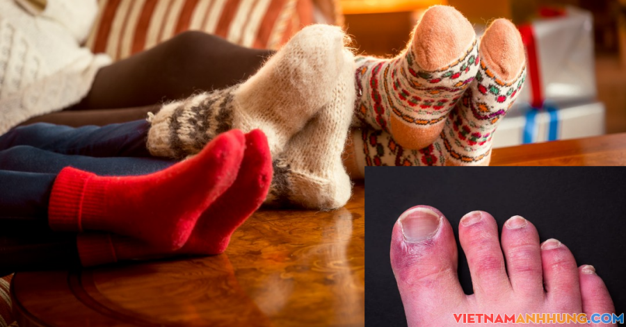 Khổ vì ngón chân sưng và ngứa vào mùa đông, làm thế nào để ngón chân không sưng, ngứa?