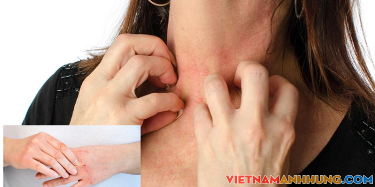 Thời tiết hanh khô da bị ngứa phải làm thế nào?
