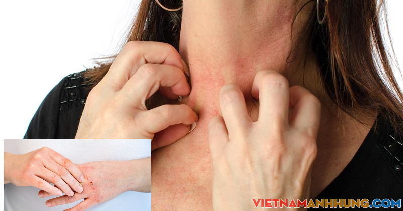 Thời tiết hanh khô da bị ngứa phải làm thế nào?