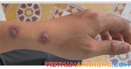 Da nổi cục chỉ sau một vết xước, không ngờ nhiễm vi khuẩn lao