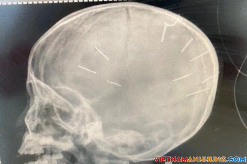 Lời khai ban đầu của nghi phạm vụ cháu bé 3 tuổi bị đóng đinh vào đầu