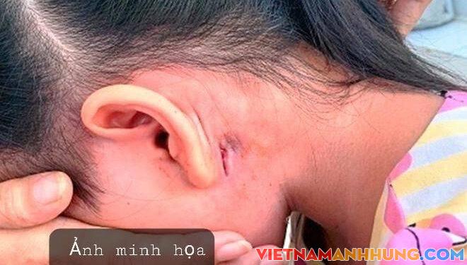 Phát hiện trường hợp mắc bệnh  “vi khuẩn ăn thịt người” ở Đắk Lắk